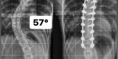 Cirurgia para Escoliose em Goiânia - Dr. Vinicio Nunes Nascimento