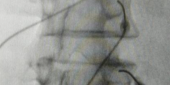 Imagem mostrando as agulhas posicionadas. Essas agulhas são conectadas ao aparelho da Rizotomia.