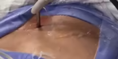 Cirurgia para Hérnia de Disco em Goiânia