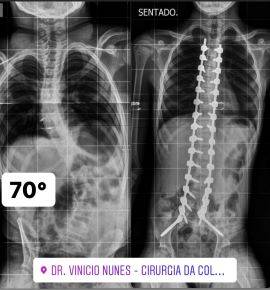 Coluna Vertebral - Escoliose Neuromuscular