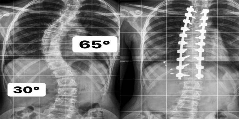 Especialista em Cirurgia para Escoliose em Goiânia - Dr. Vinicio Nunes