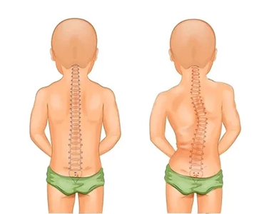 Escoliose Idiopática Infantil - Dr. Vinicio Nunes