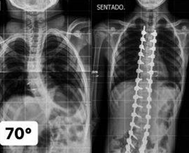 Escoliose Neuromuscular - Dr. Vinicio Nunes