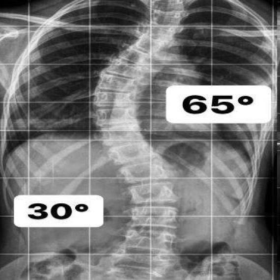 Quando é necessário realizar a cirurgia para Escoliose?