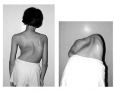 Escoliose Idiopática do Adolescente - Dr. Vinicio Nunes