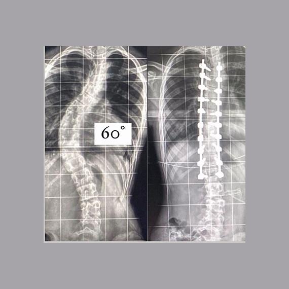 Quando é necessário realizar a cirurgia para Escoliose?